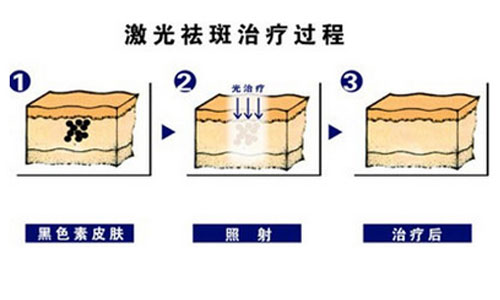 激光祛斑