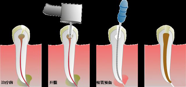 根管治疗会不会很疼