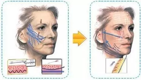 埋线提升:年轻与衰老,只在一“线”之间!
